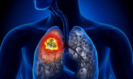 Penyakit Kanker Yang Menjadi Bad Lucky Seseorang