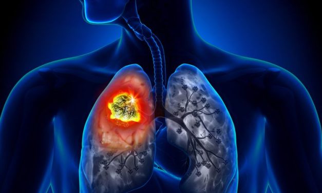 Penyakit Kanker Yang Menjadi Bad Lucky Seseorang