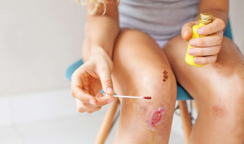 Pengobatan Luka Dengan Betadine Bahan Antiseptik