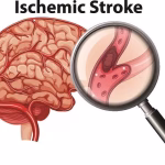 Keadaan Sakit Stroke Yang Sulit Untuk Bergerak
