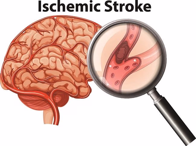 Keadaan Sakit Stroke Yang Sulit Untuk Bergerak